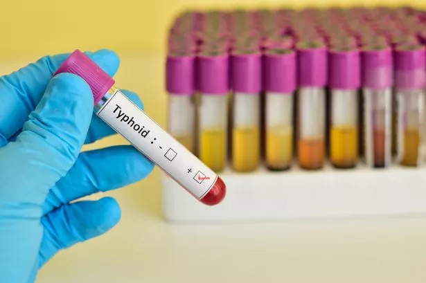 Blood sample positive with typhoid disease
