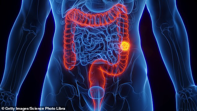 In a major study spanning two decades, scientists at the Cleveland Clinic in the US found that exposure to fine particulate matter ¿ known as PM2.5 ¿ ¿significantly¿ raises the risk of dying from bowel cancer