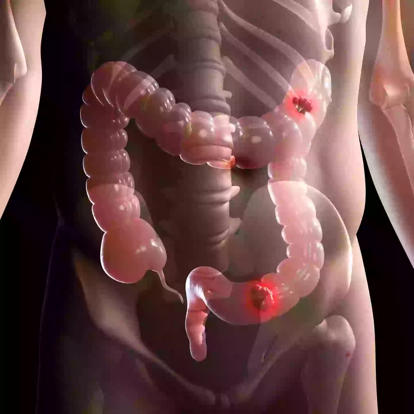 There are roughly 16,800 bowel cancer deaths in the UK every year, according to Cancer Research UK (Getty Stock Images)